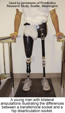 Prosthetic legs for below knee amputation level